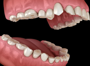 desgaste dental en Jerez