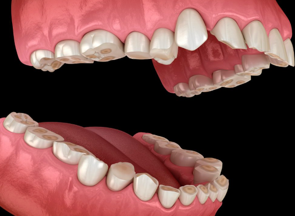 desgaste dental en Jerez