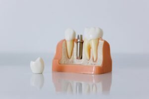 Implantes Dentales periodontitis